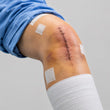 Post Surgery