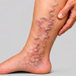 Varicose Vein